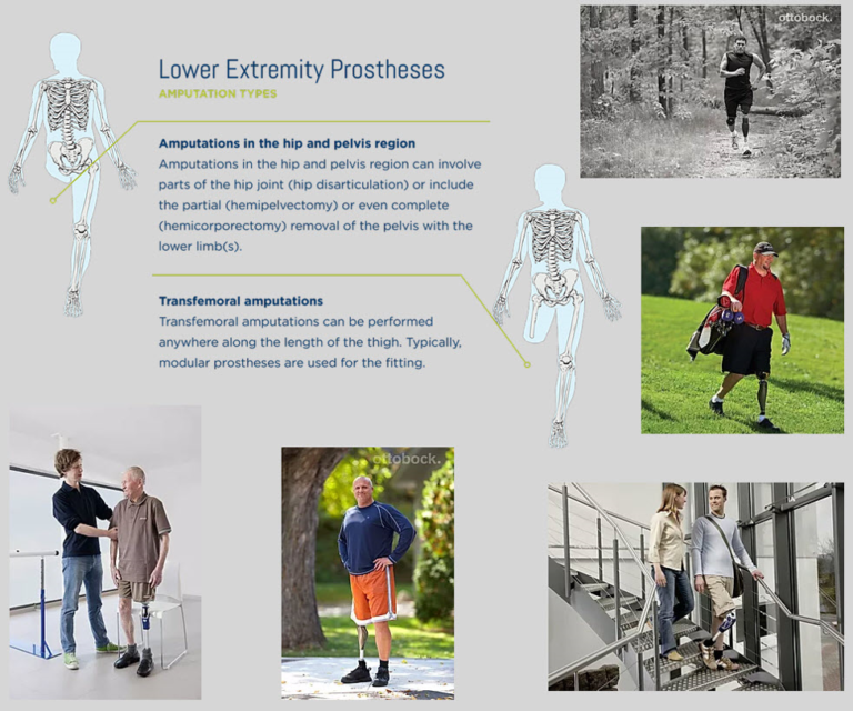 3 Types of Technologically Advanced Above the Knee Prosthetics